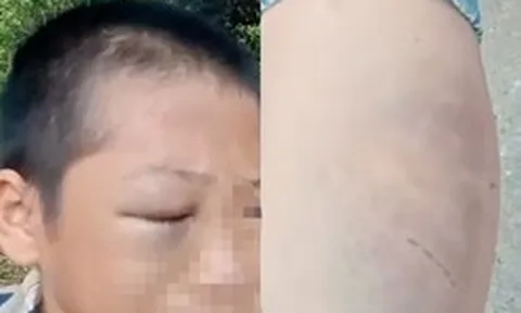 Xôn xao clip bé trai mắt bầm tím, khóc kêu cứu vì nhiều lần bị đánh đập khi ở cùng bố và vợ mới
